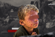الأمراض الجلدية تصيب أطفال غزة