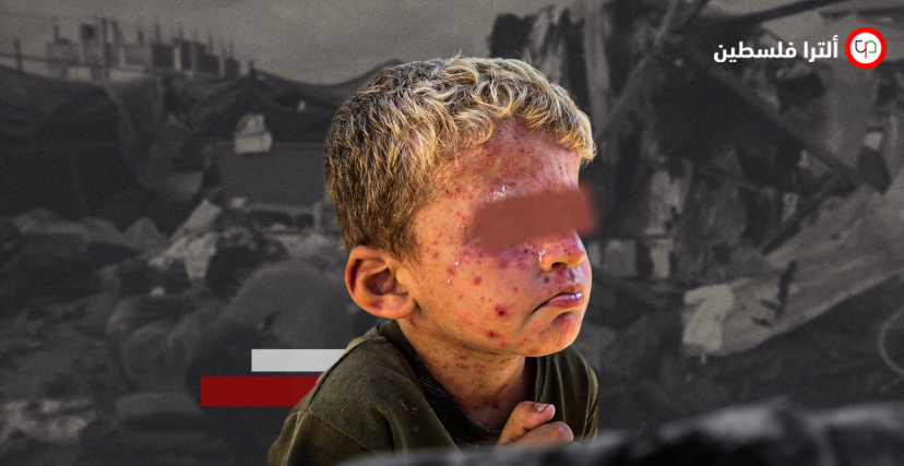 الأمراض الجلدية تصيب أطفال غزة